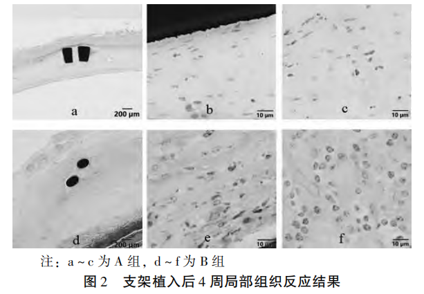 【艾佧医学】镍钛合金血管支架植入后再狭窄的组织病理评价研究